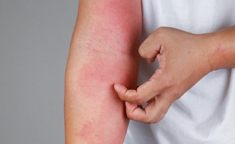 orticaria nei bambini